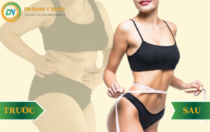 có nên hút mỡ không