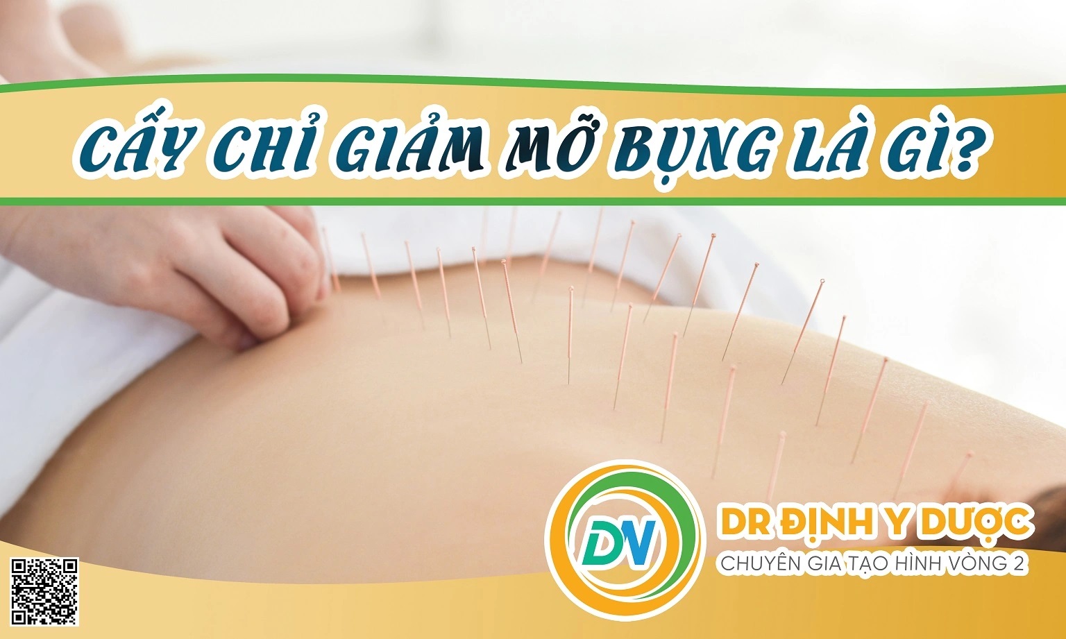 Cấy Chỉ Giảm Mỡ Bụng Là Gì?