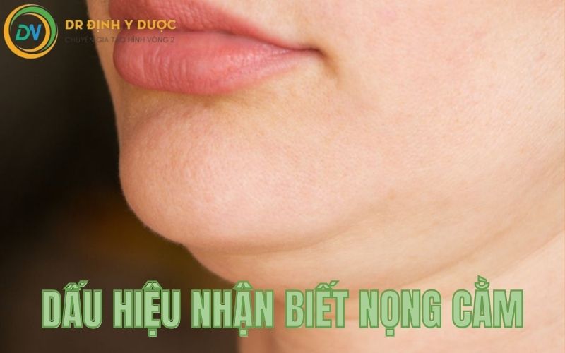 dấu hiệu nhận biết nọng cằm