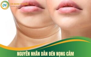 Nguyên Nhân Dẫn Đến Nọng Cằm Và 1 Số Cách Loại Bỏ Nọng Cằm Hiệu Quả