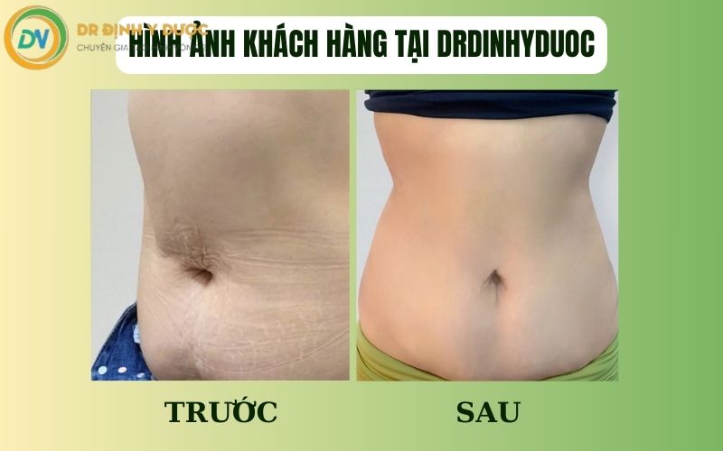 hút mỡ bụng bao lâu thì hồi phục