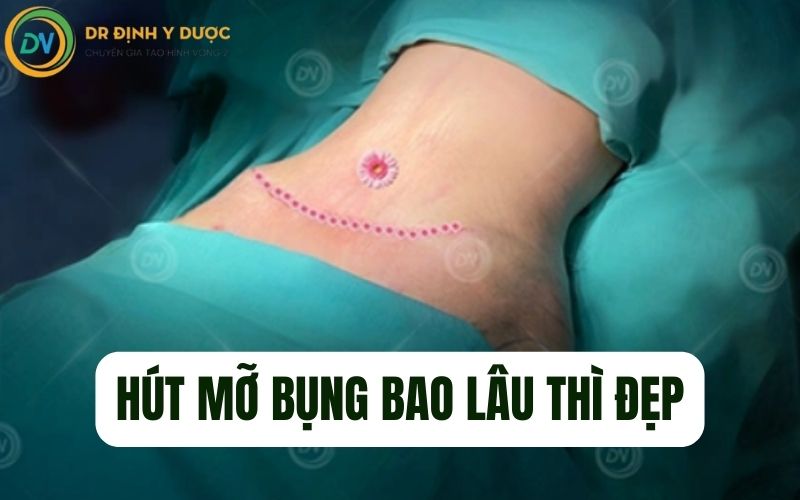 hút mỡ bụng bao lâu thì đẹp