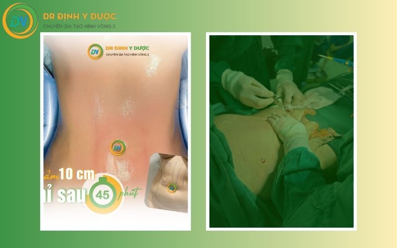 chiếu đèn hồng ngoại giảm mỡ bụng phương pháp thay thế