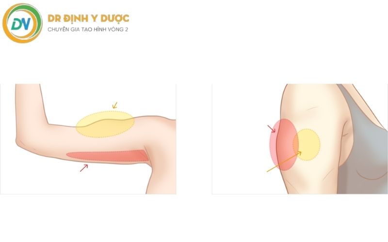 rủi ro khi tiêm giảm mỡ bắp tay