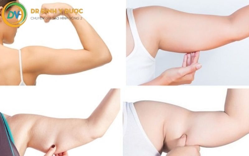 ưu nhược điểm của tiêm giảm mỡ bắp tay