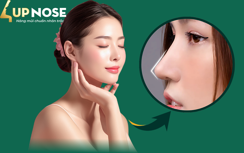 nâng mũi