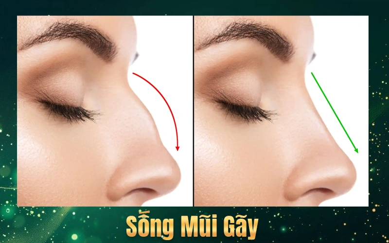 Nguyên nhân dẫn đến mũi gãy