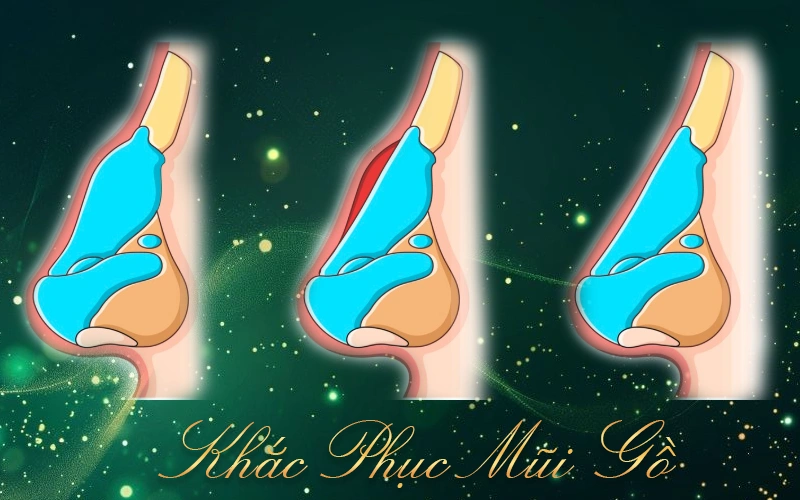 Các phương pháp sửa mũi gồ phổ biến