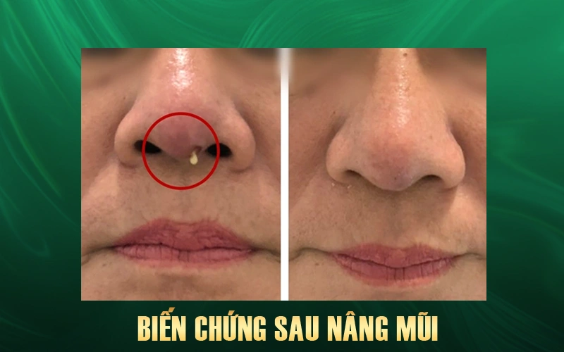 biến chứng trễ sau nâng mũi