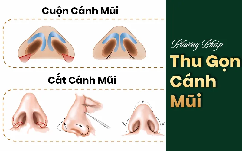 phương pháp thực hiện thu gọn cánh mũi