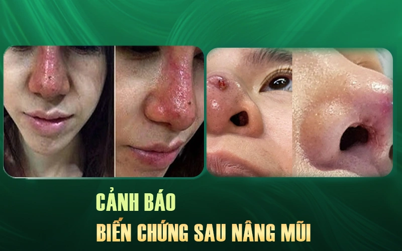 biến chứng sau nâng mũi