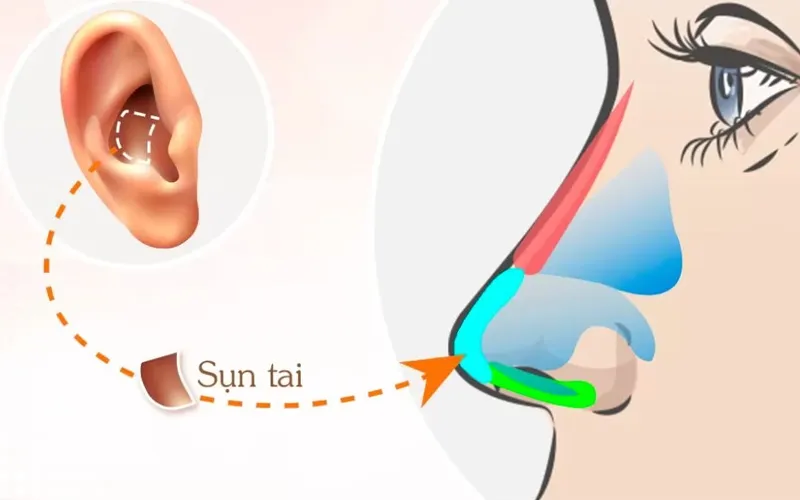 Hạn chế của nâng mũi sụn tai