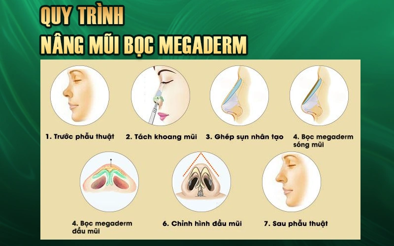 Quy trình nâng mũi bọc Megaderm