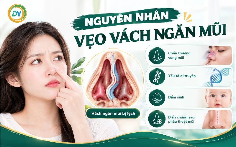 Nguyên nhân vẹo vách ngăn mũi